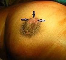 Gonorrhea condom failure rate